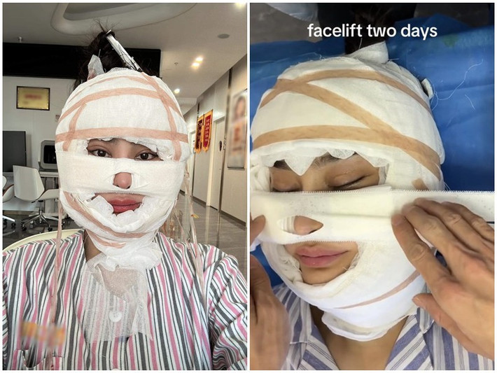 Mới đây, video ghi lại quá trình căng da mặt của Lâm Khánh Chi gây chú ý. Theo Người Đưa Tin, nữ ca sĩ chuyển giới sang Trung Quốc "dao kéo". Ảnh: Người Đưa Tin.
