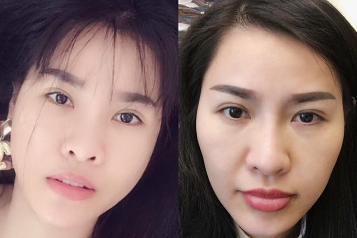 Gần đây, nữ ca sĩ Quế Vân vướng nghi vấn dao kéo khi gương mặt của cô khác trước rất nhiều, thậm chí bạn bè cũng phải ngạc nhiên. Sau thời gian giữ im lặng, Quế Vân vừa lên tiếng thừa nhận đã dao kéo gương mặt vào hơn 1 tháng trước tại Hàn Quốc. Ảnh: FBNV