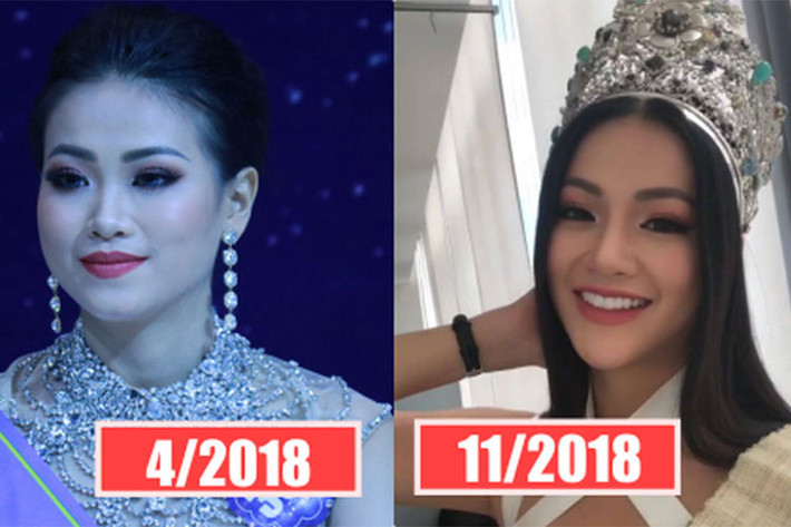 Gương mặt thay đổi chóng mặt của tân Hoa hậu Trái đất Phương Khánh được anh trai của người đẹp cho rằng là do bó mặt. Ảnh: Thế giới trẻ