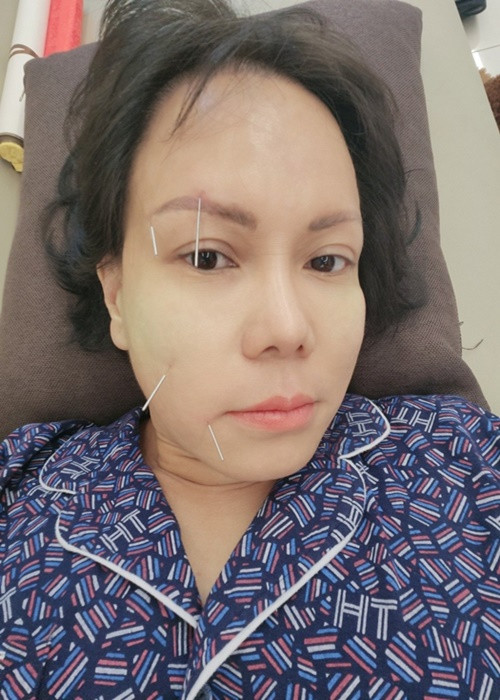 Đến chiều ngày 5/4, Việt Hương châm cứu và hơ ngải cứu. Nữ nghệ sĩ cho biết, bác sĩ nói may mắn vì phát hiện kịp thời nên không ảnh hưởng quá nhiều đến sức khỏe. Ảnh: Vietnamnet