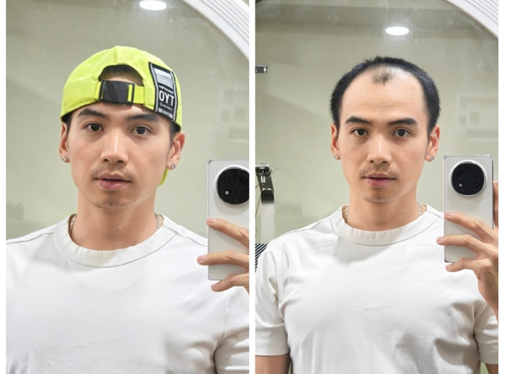Nhiếp ảnh gia Tuấn Khôi rơi vào tình trạng rụng tóc nhiều khiến anh thường xuyên phải đội mũ khi đi ra ngoài. Để tự tin hơn, chồng H’hen Niê đi cấy tóc. Ảnh: FB Tuấn Khôi.