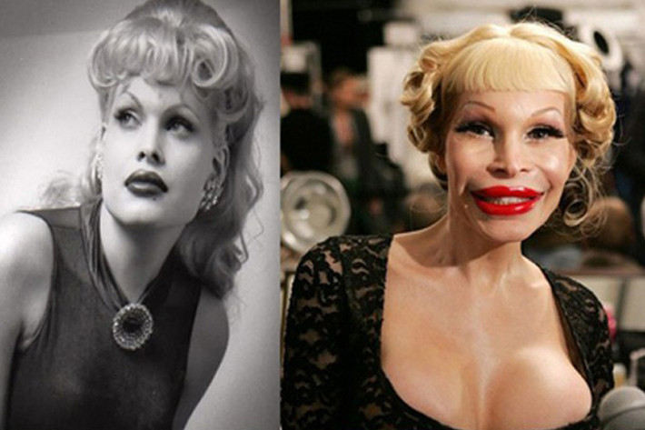 Người mẫu chuyển giới Amanda Lepore làm mũi lần đầu tiên năm 15 tuổi. Từ đó cô liên tiếp bị nghiện phẫu thuật thẩm mỹ. Giờ đây cô khiến gương mặt và thân hình mình trở nên méo mó.