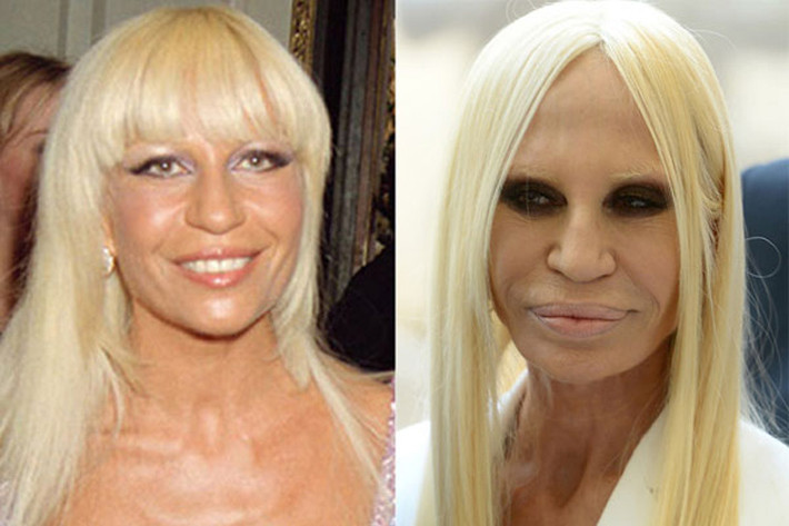 Phó tổng giám đốc tập đoàn danh tiếng Versace, Donatella Versace bị hẹp phần cánh mũi khiến gương mặt mất tự nhiên. Cộng với hậu quả của những cuộc trùng tu nhan sắc khác như bơm môi, căng da mặt, tiêm chất độn, tiêm botox khiến nhà thiết kế thời trang này bị biến dạng gương mặt.