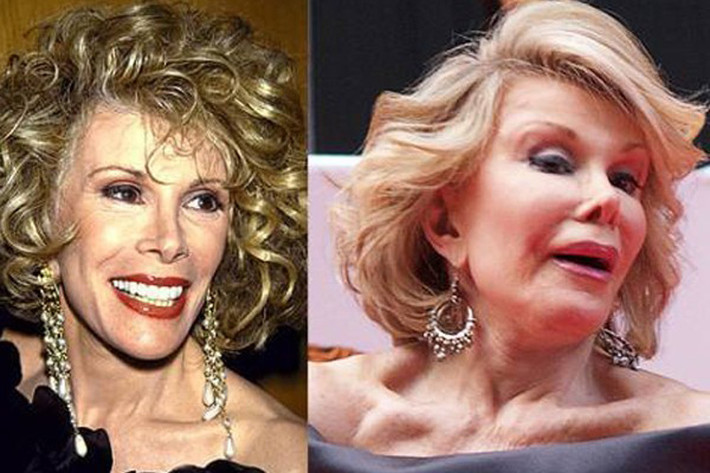Người dẫn chương trình Joan Rivers trở thành một trong những “thảm họa dao kéo” sau khi làm một loạt phẫu thuật như nâng chân mày, cắt mí, phẫu thuật xương hàm, tiêm botox. Đặc biệt chiếc mũi nhọn hoắt, biến dạng khiến cư dân mạng chỉ trích việc mê muội “dao kéo” của Joan Rivers.