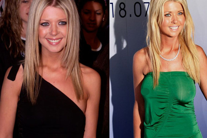 Năm 2004, nữ diễn viên Tara Reid dao kéo để khắc phục vòng 1 không cân đối. Định tăng lên kích cỡ cúp B, cô phát hiện bị nhầm nâng lên cỡ lớn hơn là C.