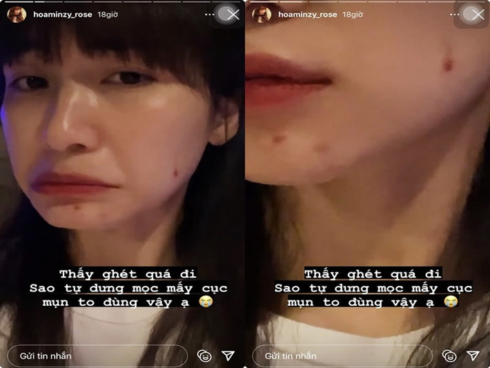 Nữ ca sĩ không ngại chia sẻ hình ảnh làn da mụn. Ảnh: Phụ nữ Việt Nam
