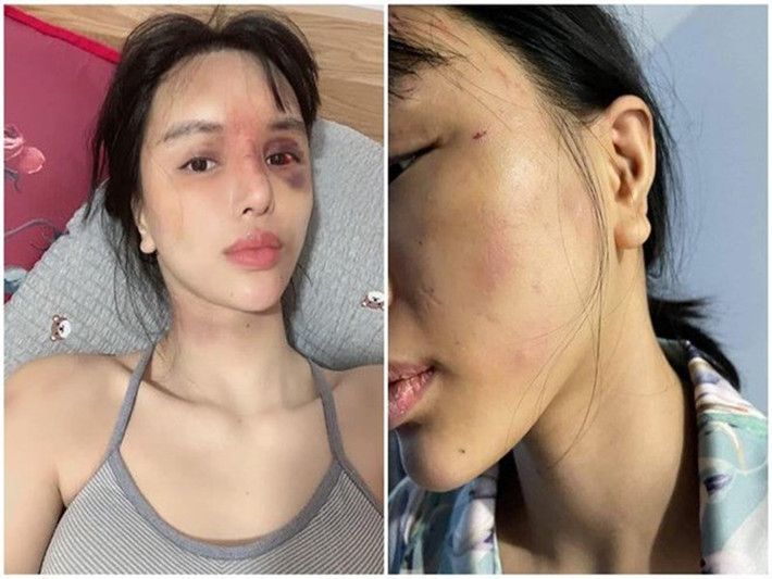Mới đây, trên trang cá nhân, siêu mẫu Khả Trang đăng ảnh bầm tím khắp người. Ảnh: Sức khỏe và đời sống