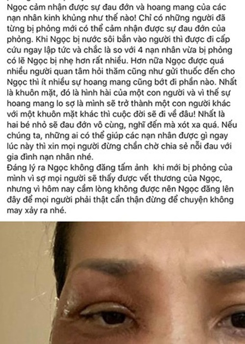 Sự cố Hồng Ngọc bị bỏng do nổ nồi xông hơi xảy ra vào năm 2020. Đàm Vĩnh Hưng tiết lộ, đàn em bị bỏng đến 2/3 gương mặt.