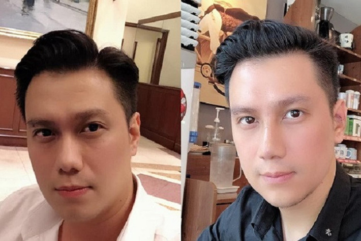 Gương mặt sau dao kéo của nam diễn viên Việt Anh đang trở thành đề tài bàn tán của dư luận. Nhiều người đặt nghi vấn anh đã gọt cằm, hút mỡ má, sửa mũi.