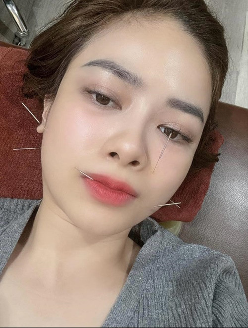 Dương Hoàng Yến châm cứu liên tục. May mắn phát hiện trong thời gian vàng và gặp bác sĩ có chuyên môn, nữ ca sĩ vẫn đi show bình thường. Ảnh: FB Dương Hoàng Yến.