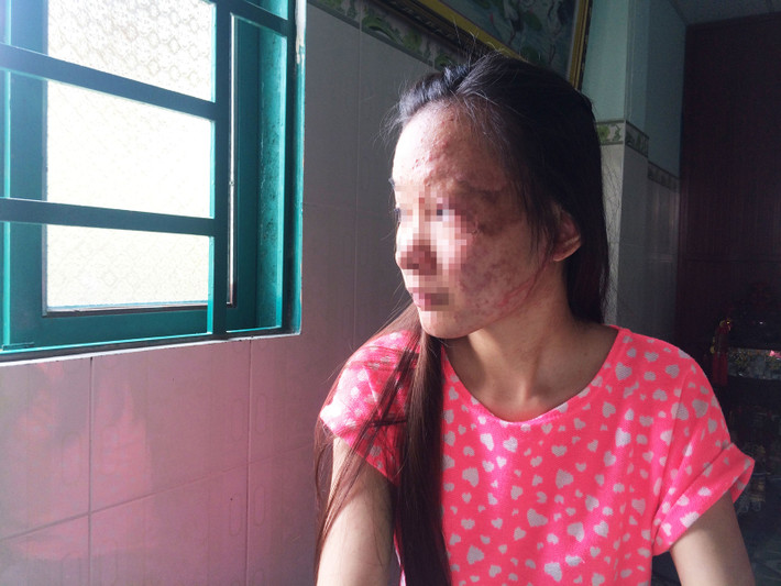 Nạn nhân bị dính axit thường bị chấn động về mặt tâm lí, hủy hoại thân thể và khiến họ không thể hòa nhập với xã hội. Phụ nữ bị tạt axit thậm chí còn đáng sợ hơn. Ngoài việc nhan sắc bị hủy hoại, họ còn rất khó tìm việc làm và lấy chồng.