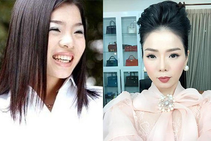 Lệ Quyên "lột xác" nhờ phẫu thuật nâng mũi. Ảnh: Saostar