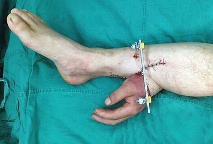 Các bác sỹ Trung Quốc vừa thực hiện một ca phẫu thuật đặc biệt để cứu bàn tay của một bệnh nhân bằng cách gắn nó vào chân của chính bệnh nhân đó trong khi chờ phẫu thuật. Đó là nguồn gốc của cảnh tay mọc từ chân như trong hình.