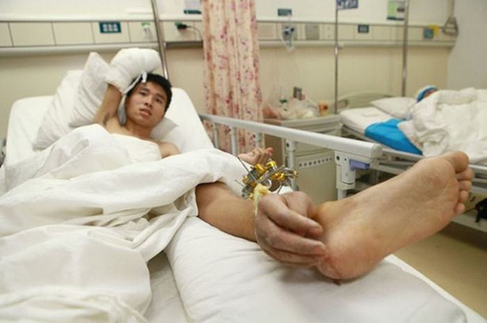 Trước đó vào năm 2013, một vụ tai nạn tương tự cũng xảy ra với Xiao Wei khiến anh bị đứt lìa một bàn tay. Và sau 1 tháng nối bàn tay vào đầu gối, các bác sỹ tại bệnh viện Thường Đức, tỉnh Hồ Nam mới có thể phẫu thuật nối lại bàn tay.