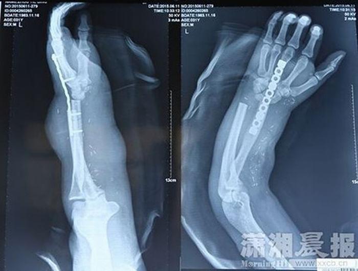 Zhou đã được đưa tới bệnh viện Xiangya để chữa trị. Tuy nhiên do bàn tay và cả cánh tay của anh đã bị thương nặng, các bác sỹ không thể nối ghép tay lại cho anh ngay nên phải nối bàn tay bị cắt rời vào chân bên phải của anh để các dây thần kinh và gân có thời gian hồi phục.