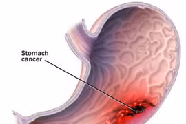 Giảm cân bằng rượu, phúc ít họa nhiều
