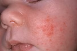 Triệu trứng trẻ sơ sinh bị dị ứng sữa
