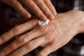 3 loại sẹo dễ phát triển thành ung thư 