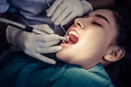 Loạt thói quen không ngờ dễ gây sâu răng
