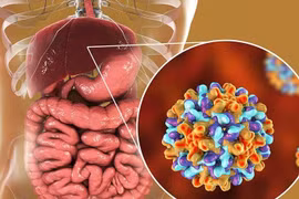 Triệu chứng ung thư gan giai đoạn đầu ít người biết