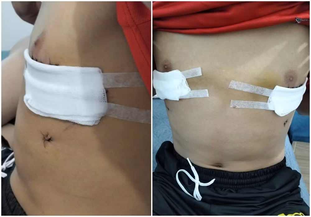 Lồng ngực bệnh nhi trở lại bình thường sau phẫu thuật. Ảnh BV