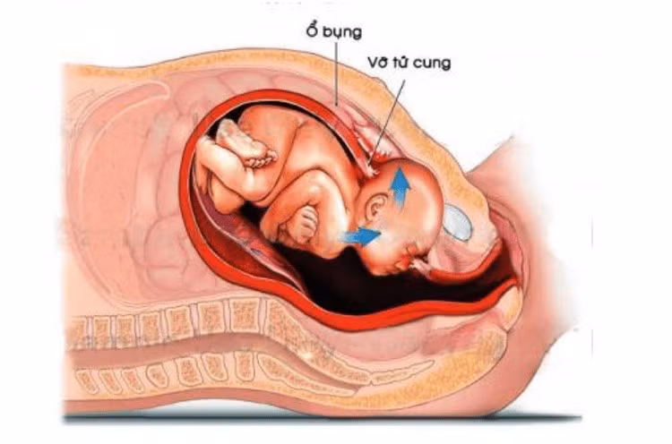 Vỡ tử cung trong chuyển dạ là một tai biến trong sản khoa. Ảnh minh hoạ/ Nguồn vinmec