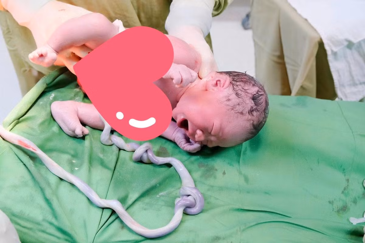 Bé trai chào đời khỏe mạnh dù dây rốn thắt hai nút. Ảnh BV