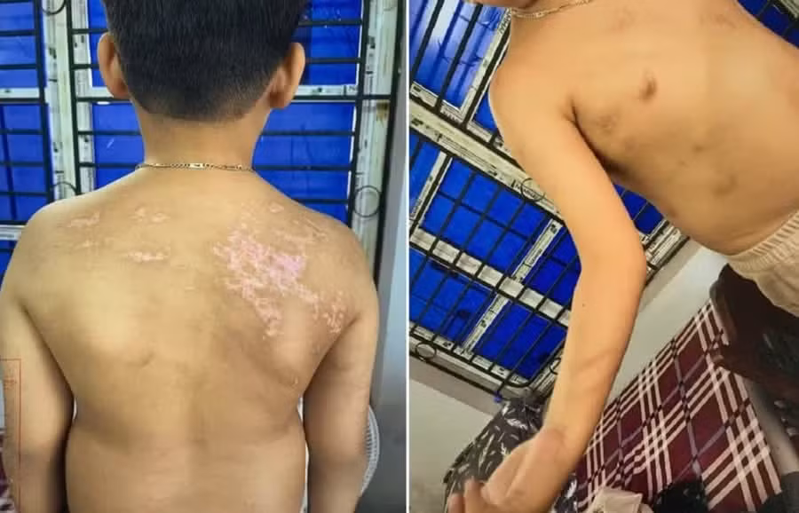 Cháu N.Đ.B.K có 21 vết sẹo và 20 vết rối loạn sắc tố da màu nâu. Ảnh báo GD&amp;TĐ