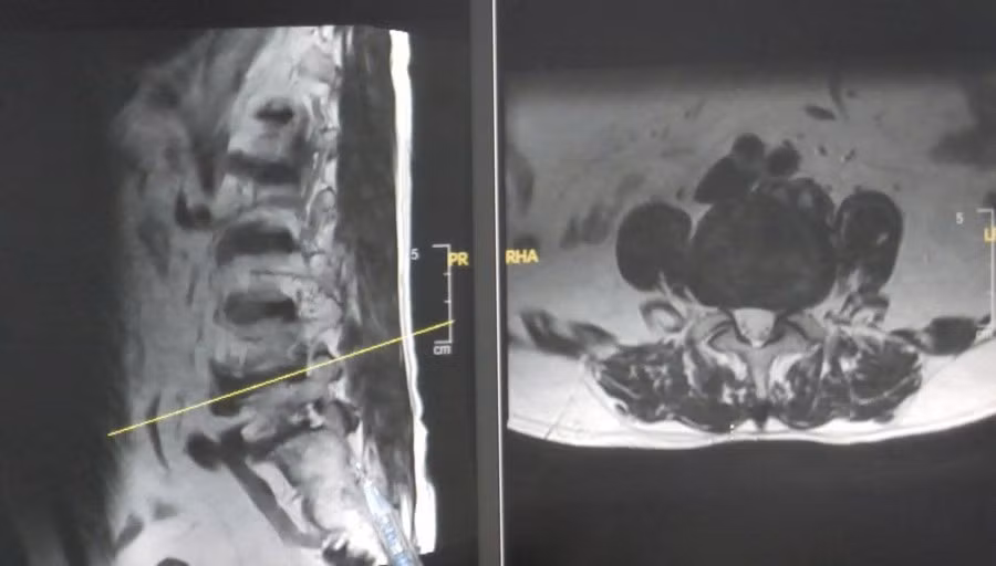 Hình ảnh MRI thoát vị đĩa đệm của bệnh nhân. (Ảnh: BVCC)