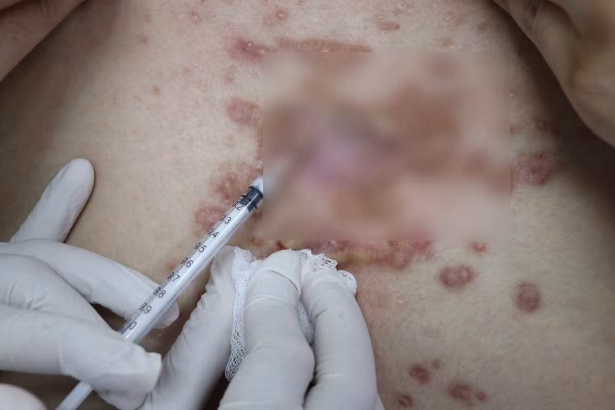 Bệnh viện Da Liễu TP HCM thường xuyên tiếp nhận người bệnh bị biến chứng khi làm đẹp ở cơ sở không uy tín. Ảnh: BV