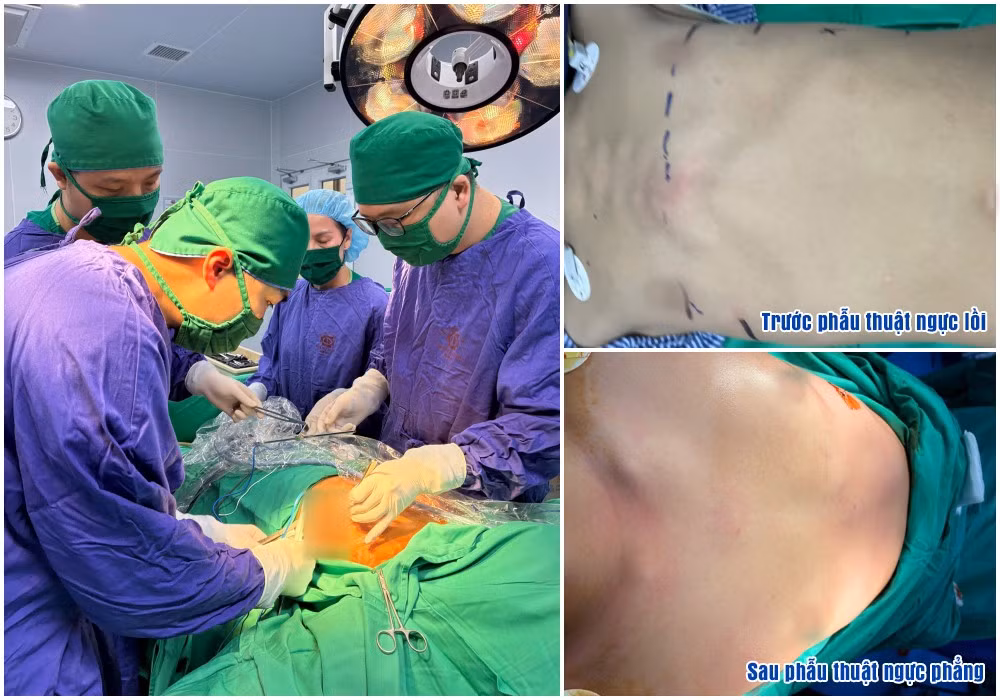 Kíp mổ khoa Ngoại thực hiện phẫu thuật Abramson chỉnh hình ngực lồi (Hình ảnh ngực bệnh nhân trước và sau mổ).Ảnh BV