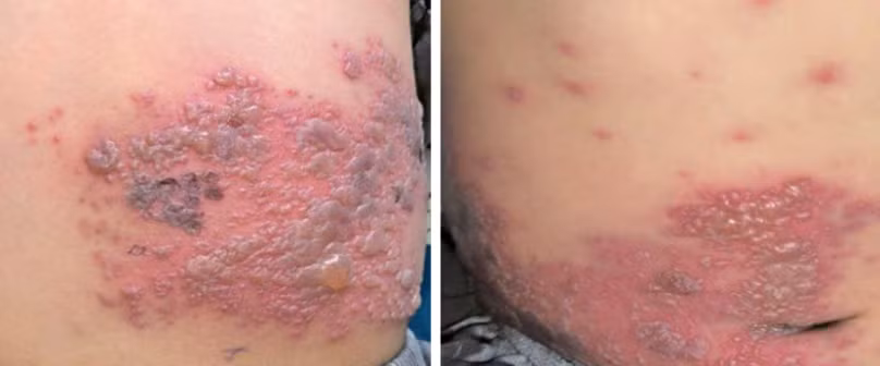 Hình 1: tổn thương mụn nước tập trung thành đám trên nền dát đỏ phân bố ở ngực, lưng ở bên phải. Ảnh BV Da liễu TW