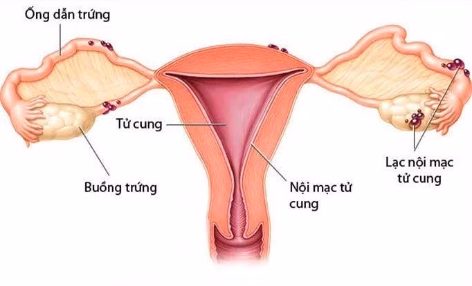 Lạc nội mạc tử cung biểu hiện rõ cơn đau bên dưới bên hông dưới