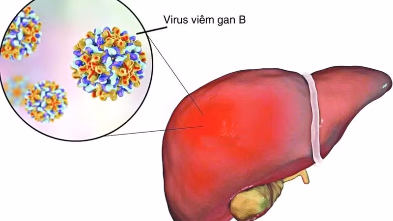 Viêm gan B là một trong những nguyên nhân ung thư gan hàng đầu. Ảnh minh họa/Internet