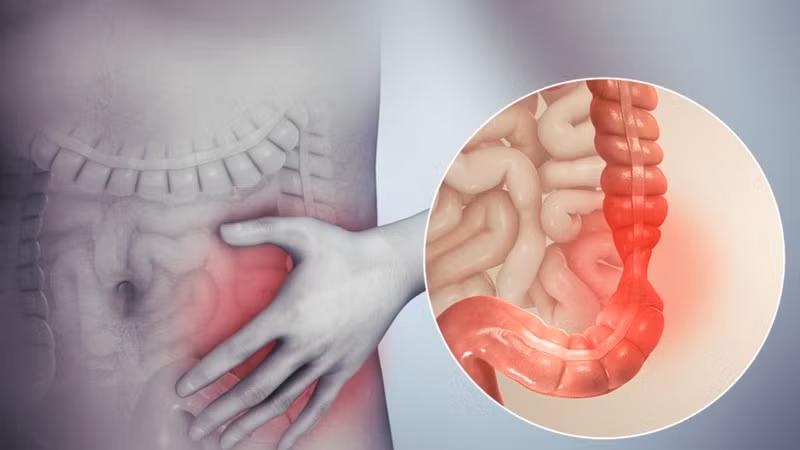 Nguyên nhân dẫn đến hội chứng ruột kích thích vẫn chưa được xác định rõ. Ảnh minh họa/Internet