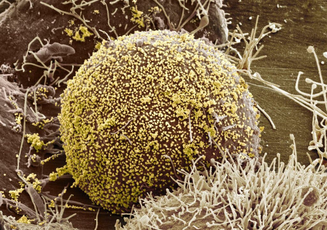 Nữ bệnh nhân HIV đầu tiên được chữa khỏi Nu benh nhan HIV dau tien duoc chua khoi