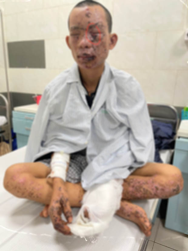 Nam thanh niên bị cháy sém toàn thân do dùng điện thoại khi đang sạc Nam thanh nien bi chay sem toan than do dung dien thoai khi dang sac