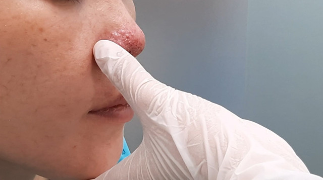 Tiêm filler, người phụ nữ bị chảy dịch vùng thái dương Tiem filler, nguoi phu nu bi chay dich vung thai duong
