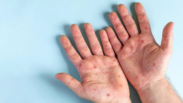 Những điều nên làm khi nghi nhiễm đậu mùa khỉ Nhung dieu nen lam khi nghi nhiem dau mua khi
