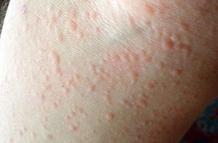WHO cảnh báo: Nửa dân số thế giới có thể mắc dị ứng vào 2050