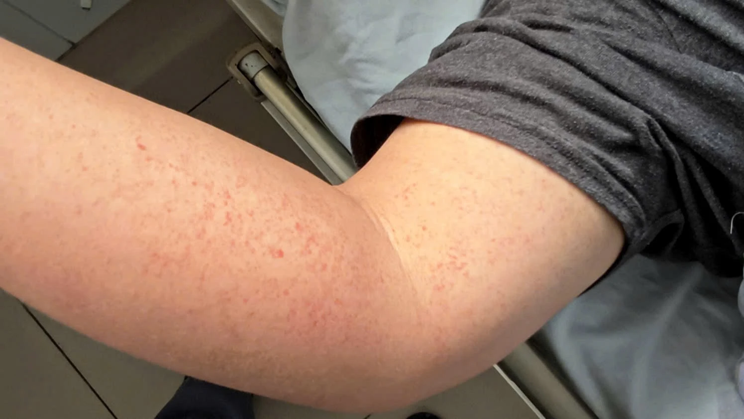 Bệnh viện Bạch Mai cảnh báo dịch sốt xuất huyết nghiêm trọng tại Hà Nội