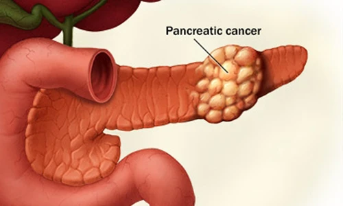 Con số khó tin về ung thư tuyến tụy