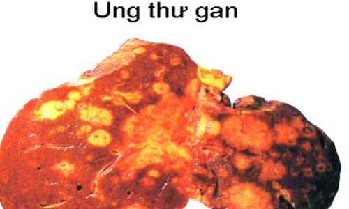 Thêm dấu hiệu đáng ngờ của ung thư gan