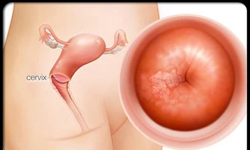 Cách phát hiện sớm bệnh ung thư tử cung