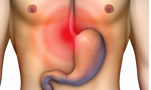 Điểm mặt thói quen gây ung thư dạ dày