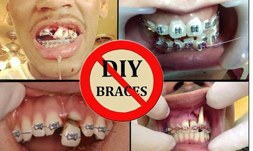 Hậu quả khủng khiếp của niềng răng bằng dây thun tại nhà