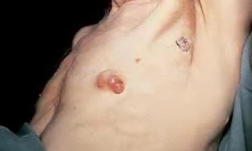 Hướng dẫn nam giới ngừa ung thư vú hiệu quả