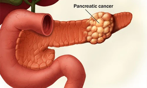 5 điều nên biết về ung thư tụy
