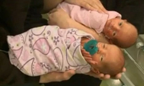 Kỳ lạ sinh đôi rồi mới biết mình mang thai