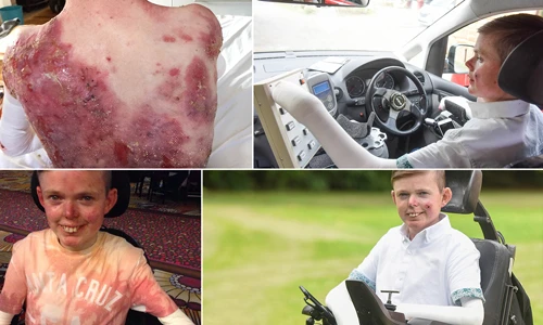 Cậu bé quấn băng 4h/ngày vì mắc bệnh da hiếm gặp